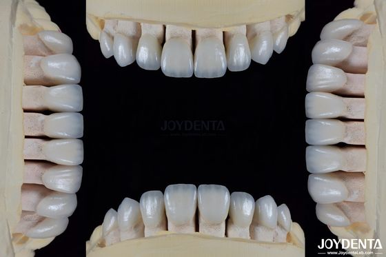 Ceramica per l' estetica naturale Finiture dentali Resistenza alle macchie Mantenere la luminosità Forte legame con lo smalto dei denti per un' adattabilità sicura
