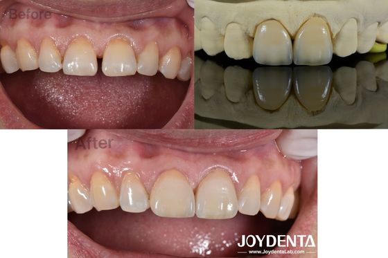 0.5mm Spessore rivestimenti dentali Perfetta permeabilità rivestimenti in porcellana per denti spaziosi