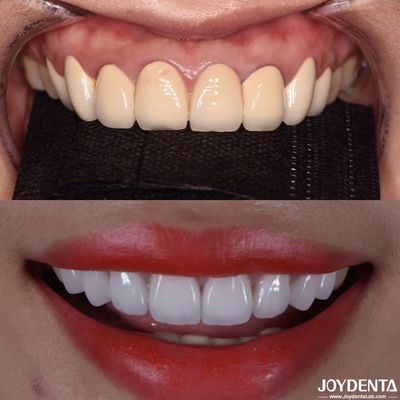 CAD/CAM Corone dentali in zirconia compatibili Fabbricazione di precisione per tonalità e dimensioni personalizzate