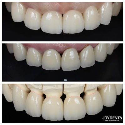 Eccellente biocompatibilità Finiture di porcellana dentale senza bisogno di processo di preparazione