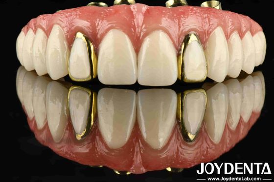 Sperimentare la durata del Titanio Malong Hybrid Bridge per l'odontoiatria applicata