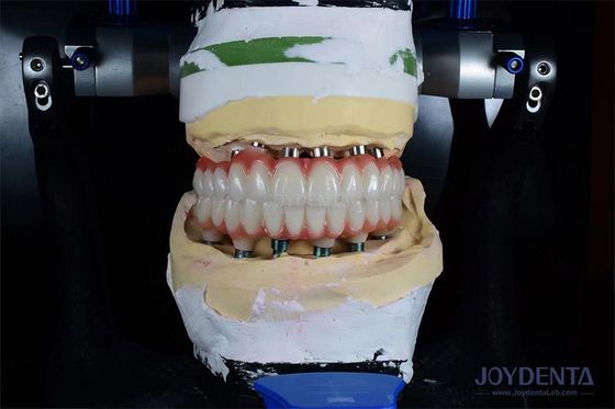 comprare Impianto mono dentale di 10 mm di lunghezza con irraggiamento gamma per risultati chirurgici ottimali fabbricazione online