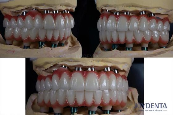 comprare Impianto dentale multiplo in titanio da 10 mm Superficie ruvida per la restaurazione dentale fabbricazione online