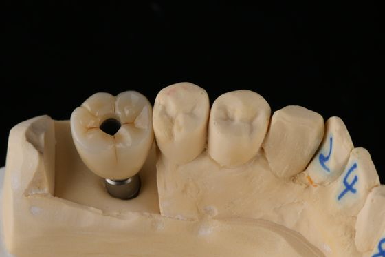 comprare 3Impianto dentale a vite in titanio di 75 mm in argento Impianto di sostituzione dentale singolo fabbricazione online