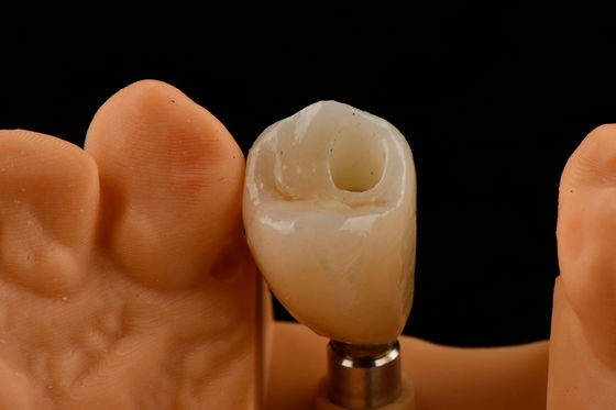comprare Impianti dentali a denti singoli in titanio Tipo di connessione esessuale interna per un'adeguatezza ottimale fabbricazione online