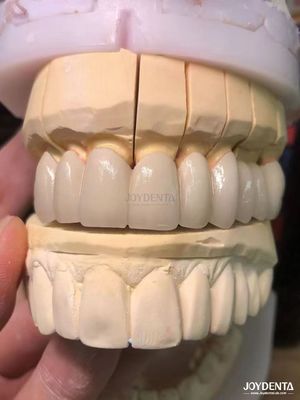 comprare Precisione adatta porcellana fusa al metallo PFM corone senza cuciture naturale miglioramento del sorriso fabbricazione online