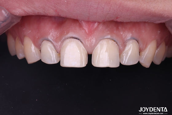 comprare Carpetti di porcellana dentale di aspetto reale Carpetti di ceramica per denti per denti anteriori fabbricazione online