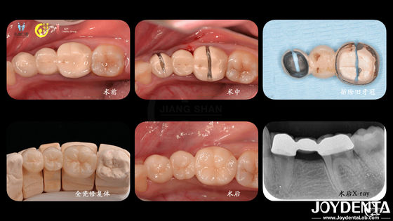 comprare Corone dentale di zirconia su misura Biocompatibilità Comfort Personalizzazione per un'esperienza ottimale del paziente fabbricazione online