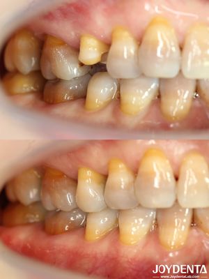 comprare Personalizzabile Prezzi accessibili Dental Inlay Restorative Precise Fit per denti danneggiati fabbricazione online