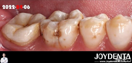 comprare Infissi dentali di colore naturale per la restaurazione dei denti danneggiati fabbricazione online
