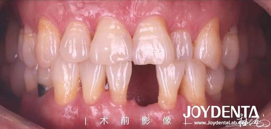 comprare Ponte dentistiche personalizzabili con legame in resina per denti anteriori e premolari fabbricazione online