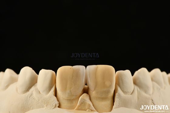 comprare 0.2 mm Spessore Microthin Veneers Veneers dentali in vetro ceramica per denti anteriori fabbricazione online