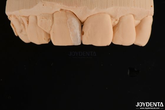 comprare Microfabricato a guscio sottile Trattamento dentale cosmetico Microfabricati a denti sottili fabbricazione online