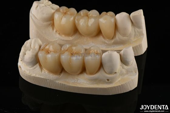 comprare Circonia resistente all'usura Corona dentale a contorno completo Alta traslucidità fabbricazione online