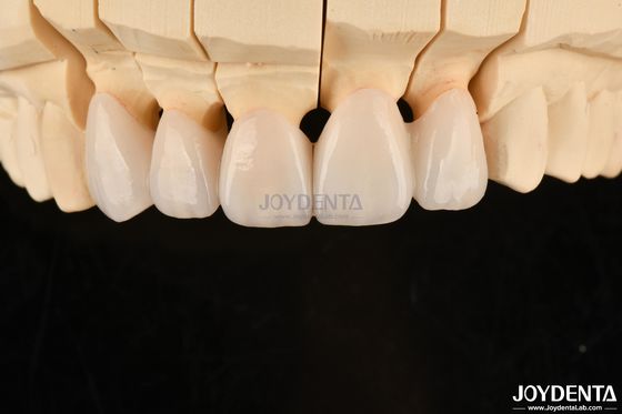 comprare Coroane e ponti dentali in zirconia a strati altamente personalizzabili Soluzione duratura fabbricazione online