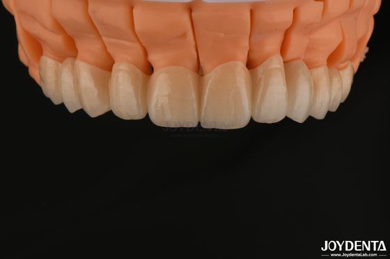 comprare Alte estetiche stratificate di zirconia corone singole ponti impianto per restauri dentali fabbricazione online