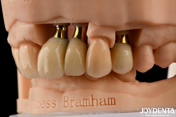 comprare Implantazione dentale di precisione Corona e ponte Soluzione perfetta per un sorriso esteticamente gradevole fabbricazione online