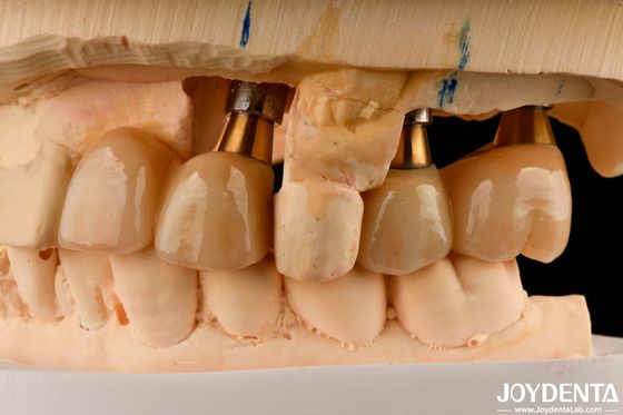 comprare Restauro dei denti mancanti Impianto corona e ponte sicuro per l' orale con un' adattabilità accurata fabbricazione online