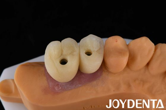 comprare Impianto di porcellana corona e ponte La soluzione definitiva per la restaurazione dei denti mancanti fabbricazione online