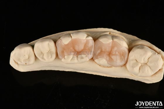 comprare Infissi dentali in porcellana polimerizzata naturale per la restaurazione dei denti fabbricazione online