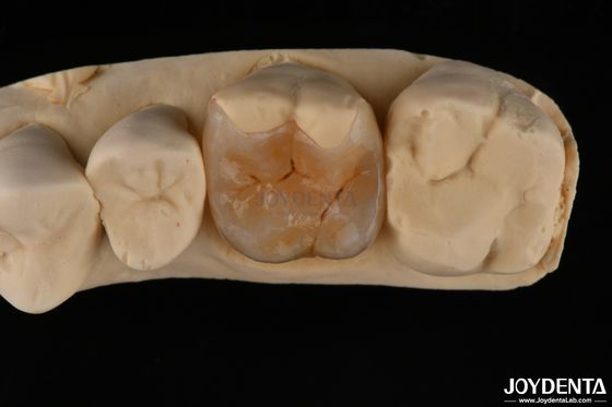 comprare Inlay composto su misura per il restauro dentale minimamente invasivo fabbricazione online