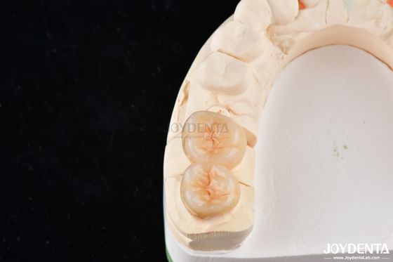 comprare Infissi di zirconia dentale dall'aspetto naturale e onlays esteticamente precisi fabbricazione online