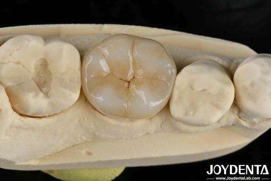 comprare Cementamento adesivo Zirconia Infissi dentistici e infissi naturali fabbricazione online