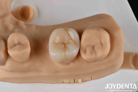 comprare Infissi dentali in zirconia ad alta resistenza e infissi per la restaurazione dei denti fabbricazione online