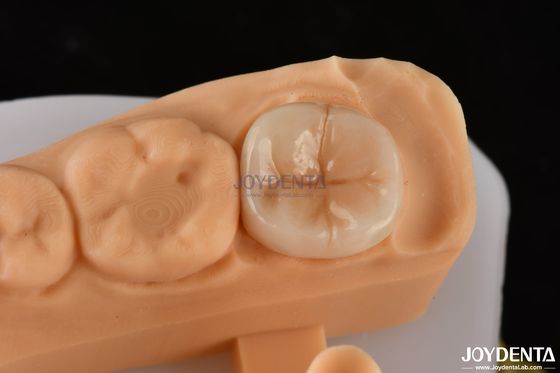 comprare 0.5mm-2mm Precise Fit Emax Dental Inlay Onlay per un'affidabile restaurazione dei denti fabbricazione online