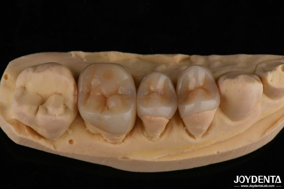 comprare Aspetto naturale Emax Inlay Onlay Restauro dentale duraturo 0,5 mm 1 mm 1,5 mm Spessore fabbricazione online