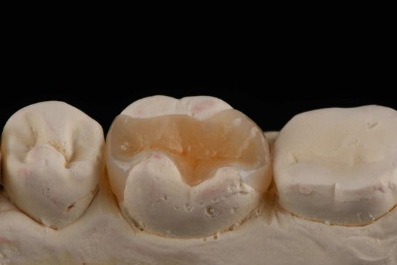 comprare E Max Material Inlay e Onlay in Odontoiatria Restauro estetico duraturo fabbricazione online