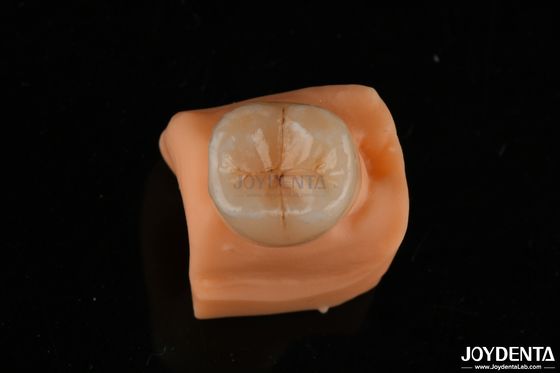 comprare 0.5mm resistente alle macchie Emax Inlay Onlay Precise Fit Per Restaurazioni Dentali fabbricazione online