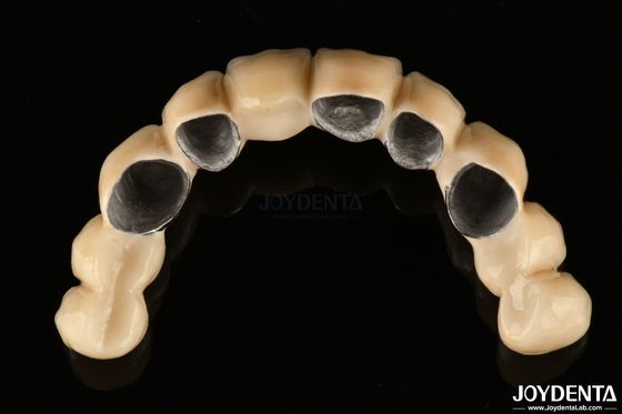 comprare PFM ceramica fusa alla corona metallica altamente biocompatibile e resistente alla corrosione fabbricazione online
