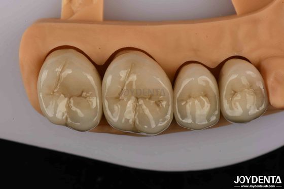 comprare Corone dentali in lega d'oro e palladio di qualità superiore per una maggiore durata fabbricazione online