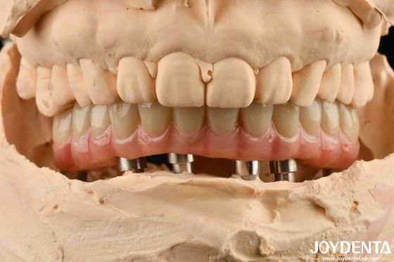 comprare Ponte di impianto dentale ibrido di titanio Malong per la perfezione dentale fabbricazione online
