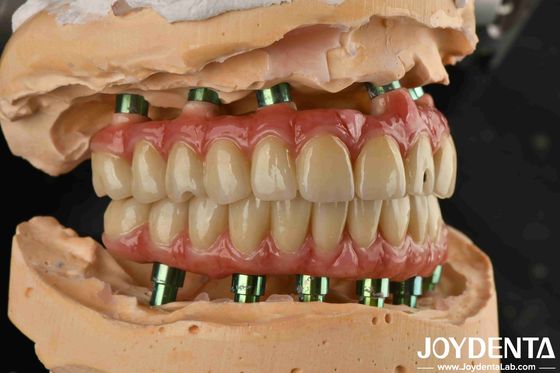 comprare Tecnologia ibrida Titanio Malong Dental Bridge regolabile per risultati estetici fabbricazione online