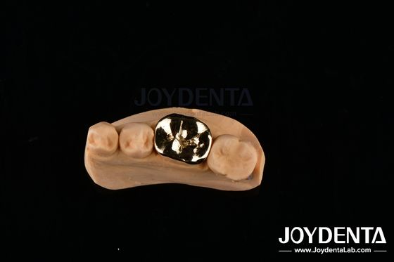 comprare FMC metallici per la riparazione clinica orale Materiali per impianti dentali resistenti agli abrasivi fabbricazione online