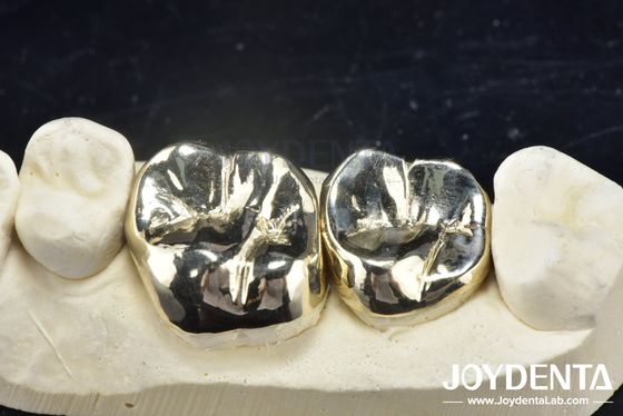 comprare Riparazione dentale con colata di cera Corona di metallo per la riabilitazione orale resistente all'abrasione fabbricazione online