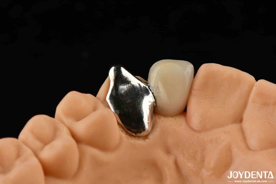 comprare Materiale metallico personalizzabile PFM Maryland Cura dentale Riparazione clinica orale fabbricazione online