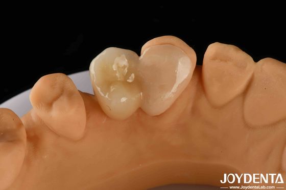 comprare Emax Maryland Veneer Clinical Bonding Adhesion per la riparazione dentale corrispondente al colore fabbricazione online