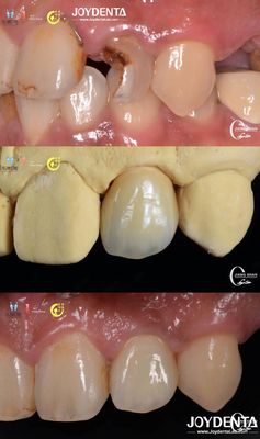 comprare Aspetto dei denti realistici Ponte di zirconia Restauro dentale resistente all'usura Personalizzato fabbricazione online