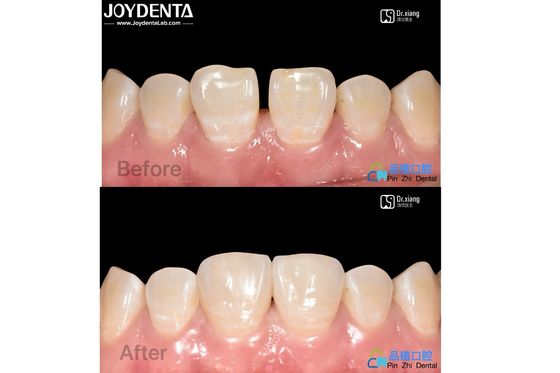 comprare Proteggere le vene di porcellana trattamento dentale vene di resina composita resistente alle macchie fabbricazione online