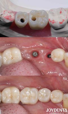comprare Impianti dentali in titanio cilindrici tutti su 4 10-16 mm di lunghezza connessione esessuale fabbricazione online