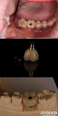 comprare 4-6 Implantazione dentale endosseo-conica, livello osseo sottocrestale e connessione esessuale interna fabbricazione online