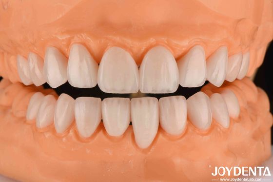 comprare Finiture di ceramica Emax spessore 0,3-0,5 mm Finiture di porcellana cosmetica di lunga durata fabbricazione online