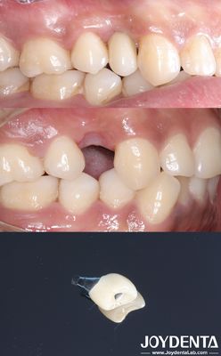 comprare Tutti su 4 Impianto dentale di forma cilindrica Titano Impianto dentale superficie ruvida fabbricazione online