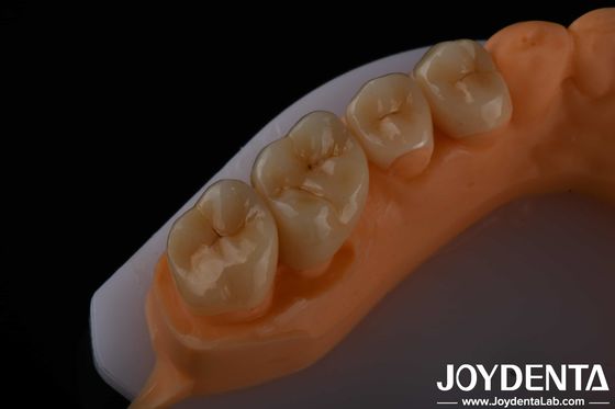 comprare Alta estetica Zirconia a contorno completo per corone ponti impianti restauri dentali fabbricazione online