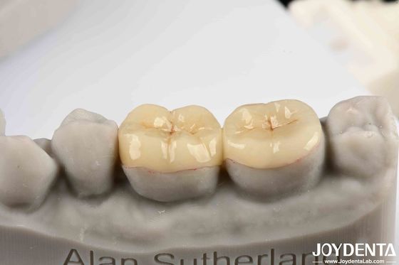 comprare Emax Inlay Onlay Precise Fit E Biocompatibilità Ipoallergenica Facile da pulire fabbricazione online
