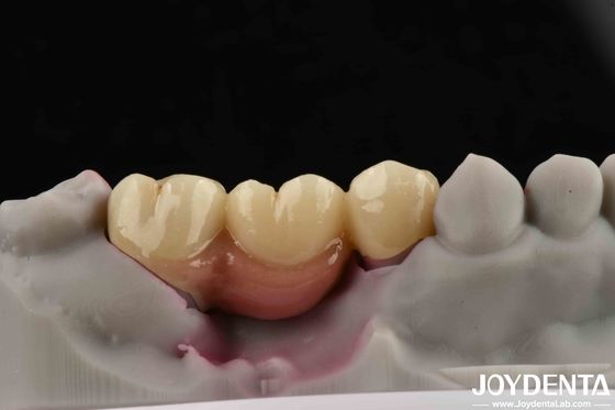 comprare Impianto dentale personalizzabile con ponte e corona per impianti dentali fabbricazione online