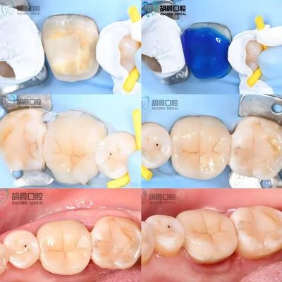 comprare Prova la precisione dell' intarsio dentale a prezzi accessibili e bianco per un' adattazione perfetta fabbricazione online